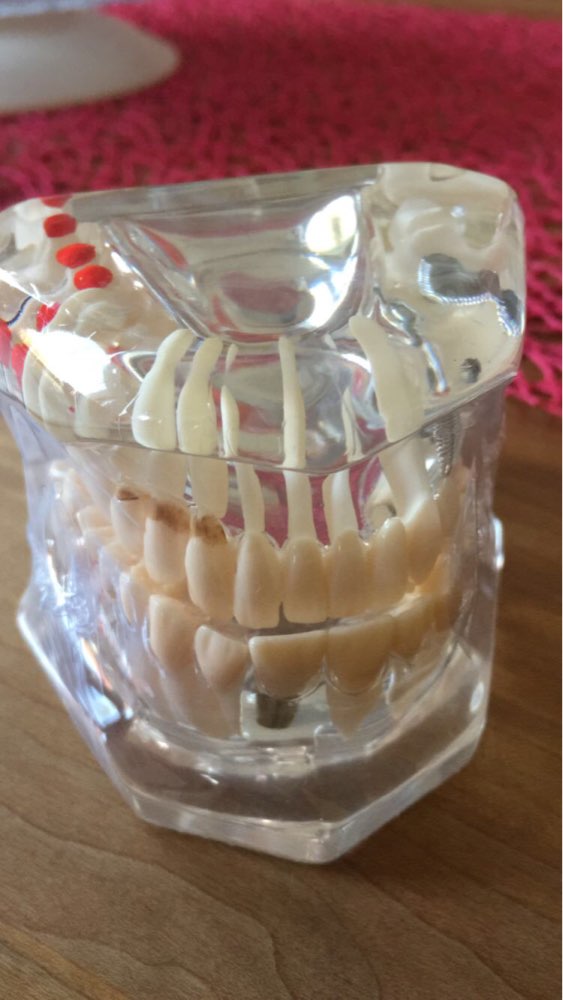 1PC Dental Implant Disease Teeth Model with Restoration Bridge Tooth Dentist for Medical Science Teaching